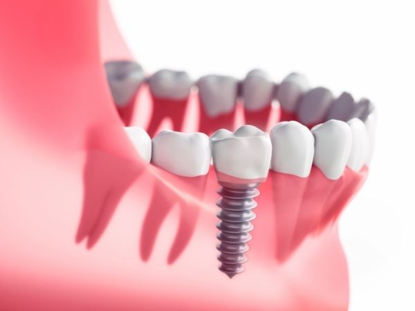 dental implants near me London Golders Green